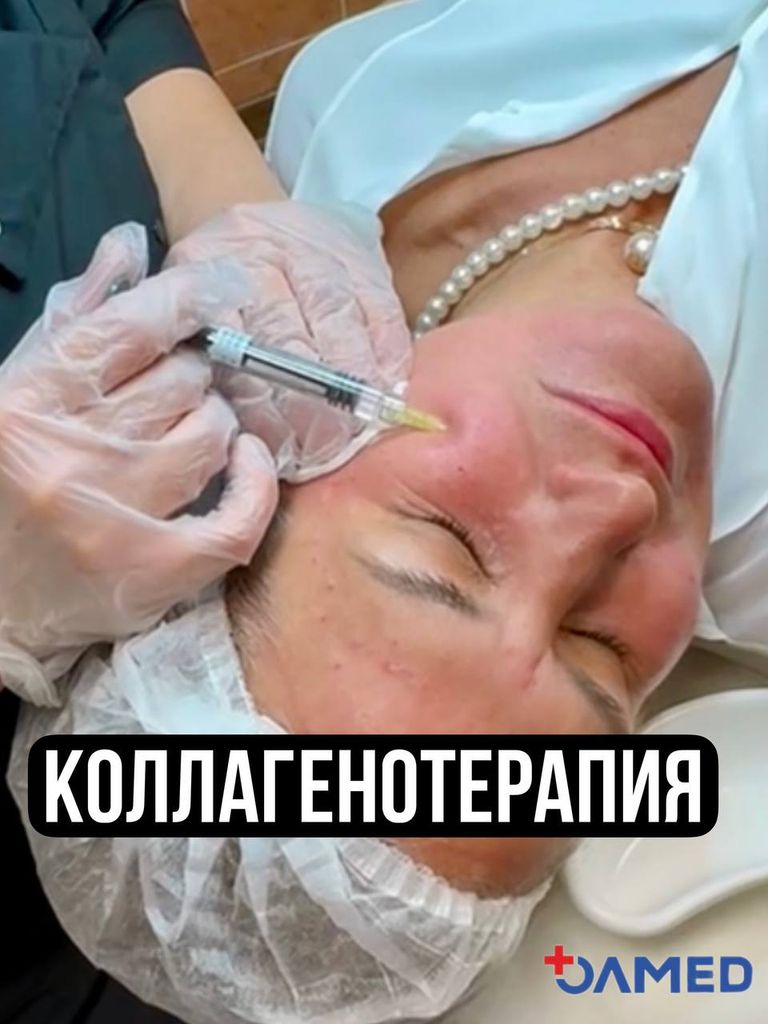 Инъекционная коллагенотерапия лица препаратом BioHyalux, 1 мл.