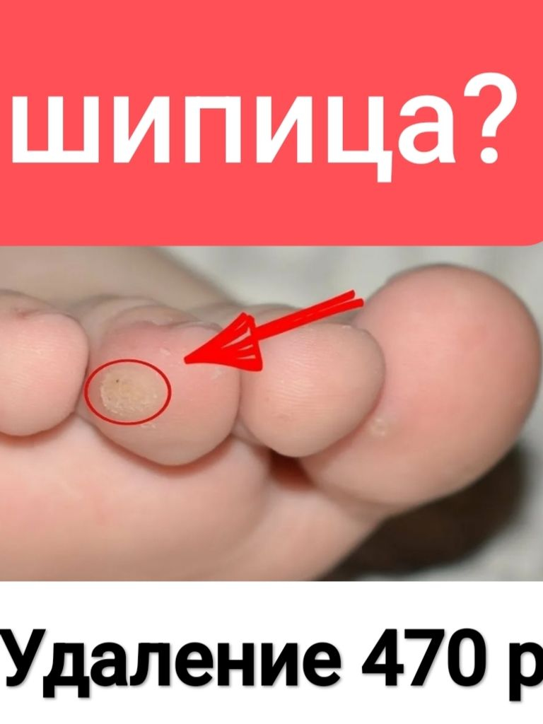 Удаление подошвенной бородавки (шипица) азотом
