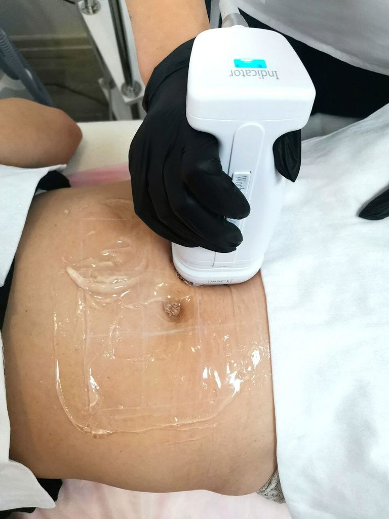Безоперационная липосакция Liposonix