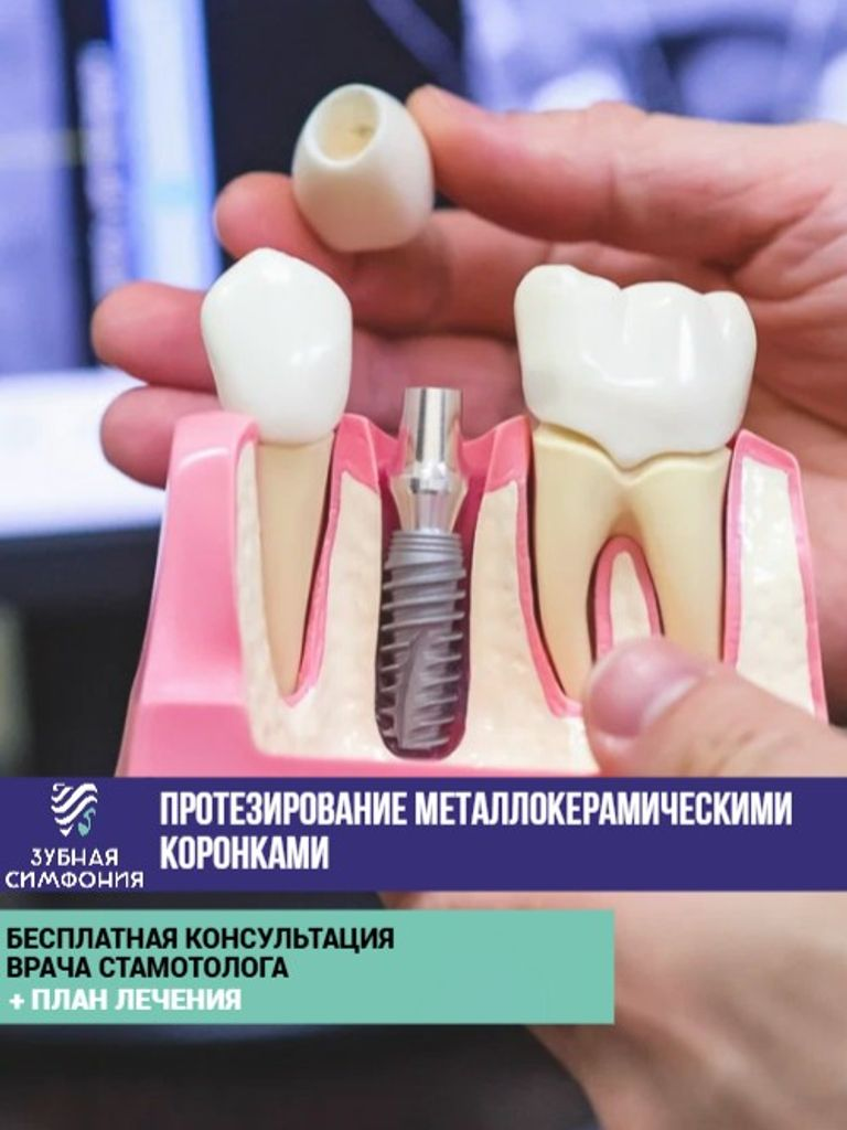 Протезирование металлокерамическими коронками, 1 ед.