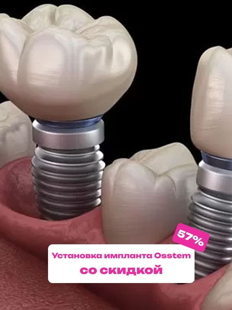 Установка импланта Osstem