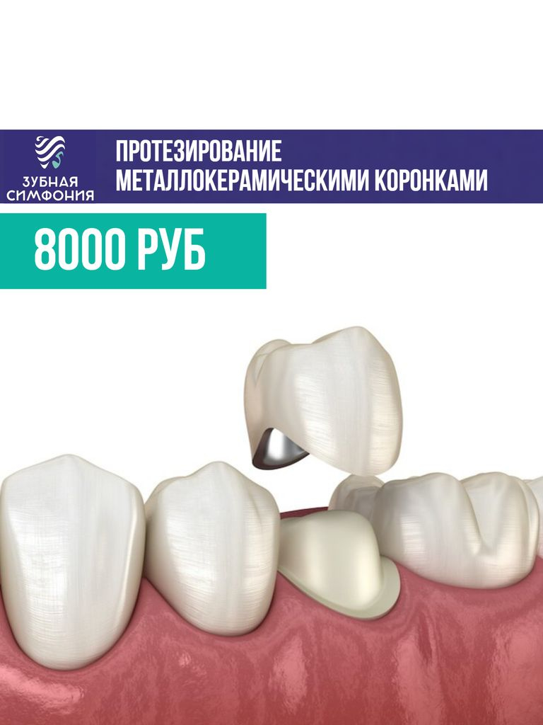 Протезирование металлокерамическими коронками, 1 ед.