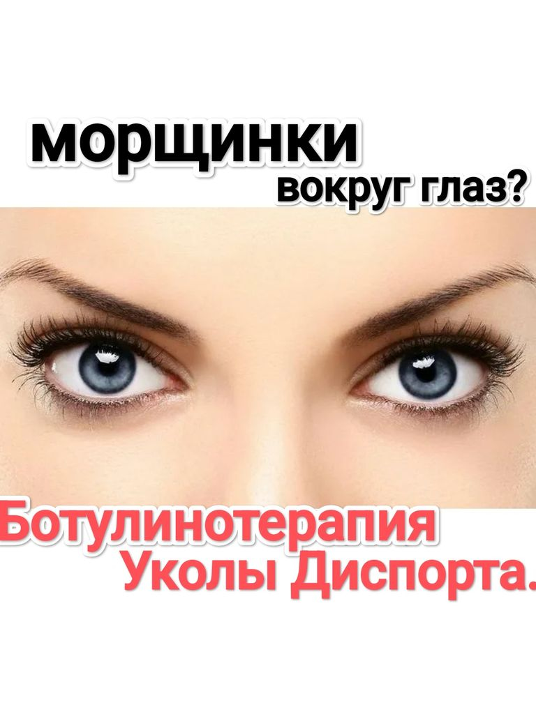 Инъекции препарата «Диспорт» в области вокруг глаз, для коррекции мимических морщин "гусиные лапки"