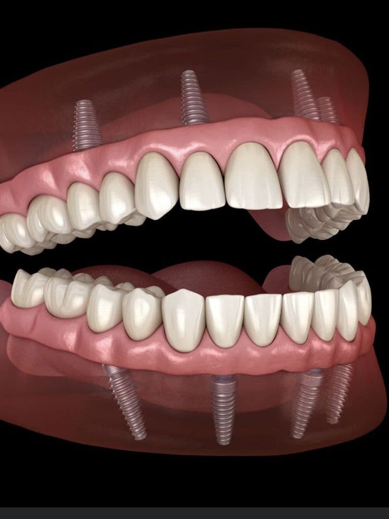 Имплантация под ключ по методу All on 4