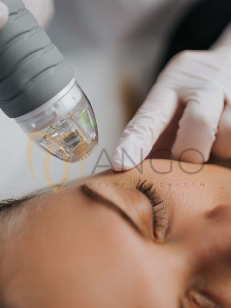 RF-лифтинг лица, шеи и зоны декольте