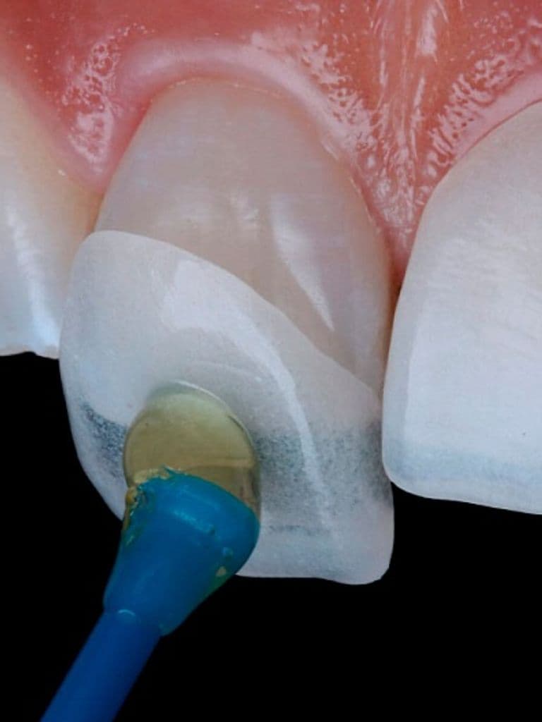 Изготовление винира