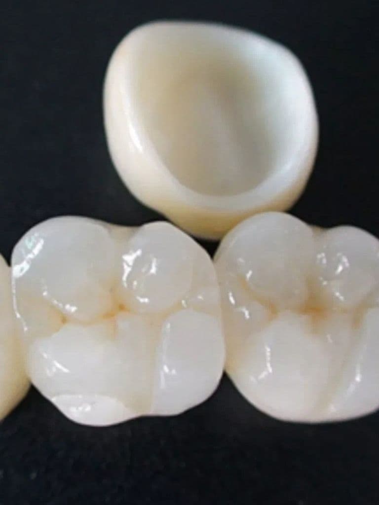 Установка коронки на зуб