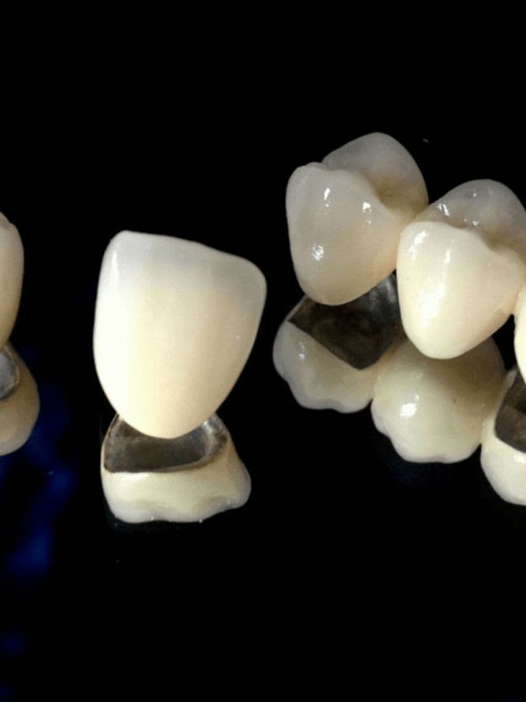 Установка коронки на 1 зуб