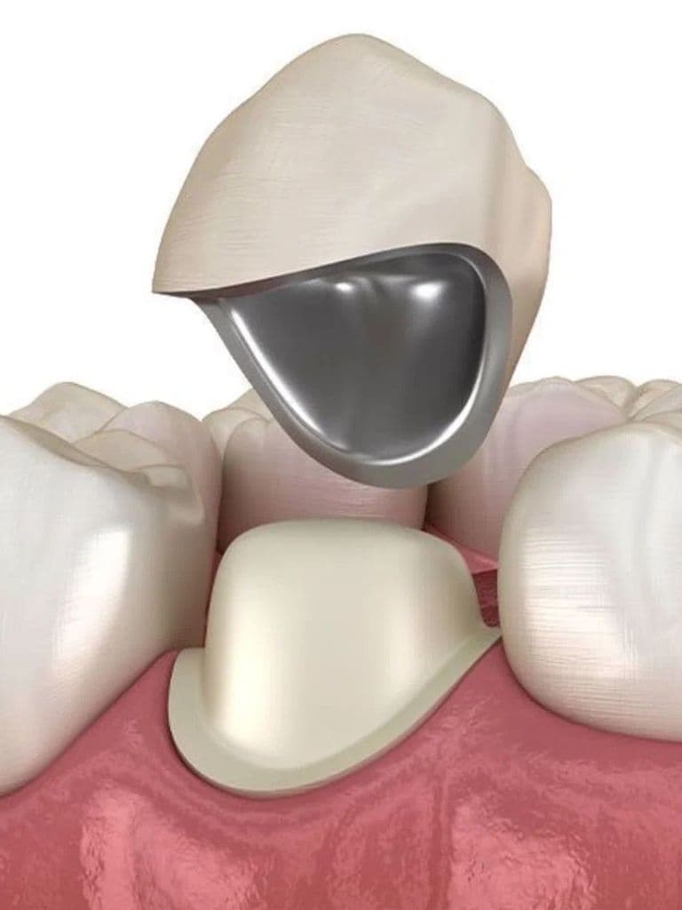 Установка металлокерамической коронки