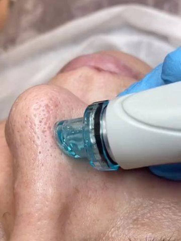 Аппаратная чистка лица (гидропилинг)