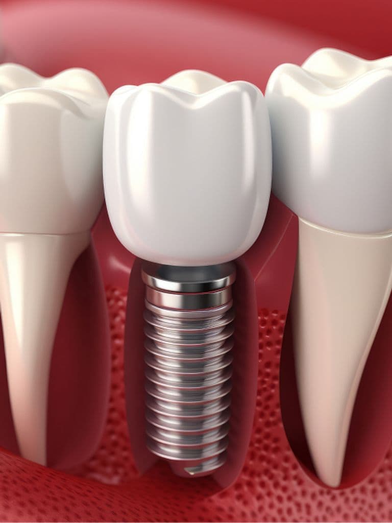 Имплантация под ключ с металлокерамической коронкой