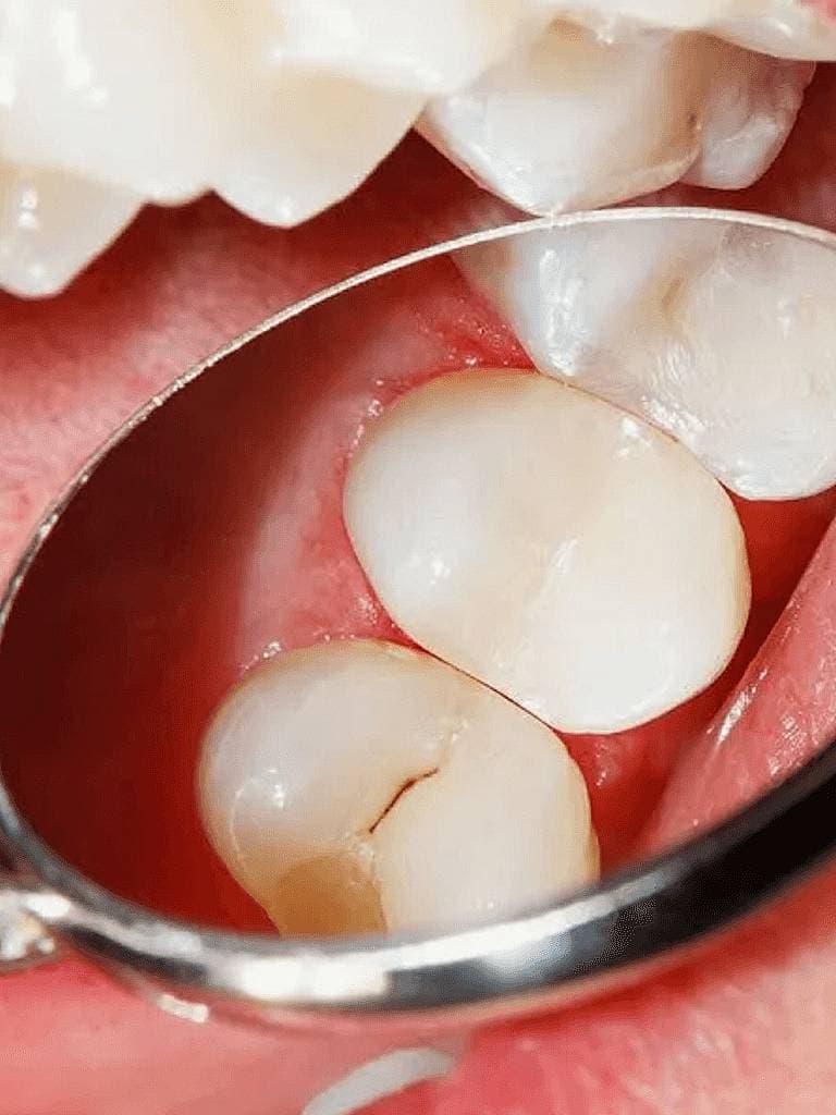 Лечение кариеса