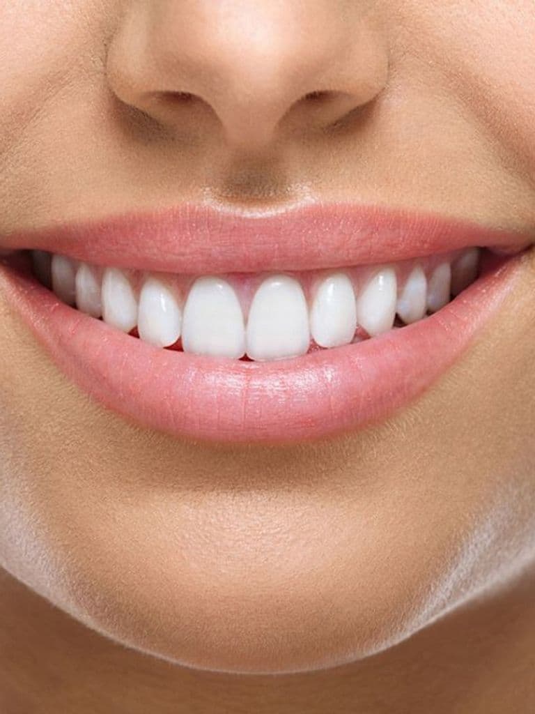 Эстетическая реставрация пломбировочным материалом