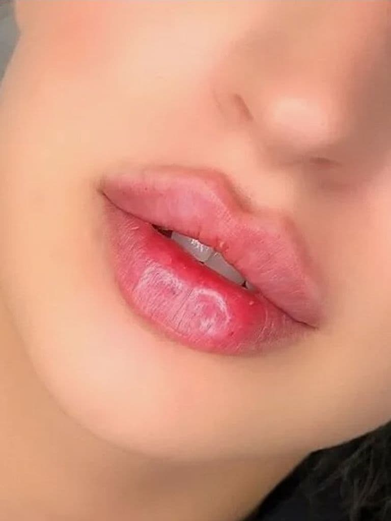 Увеличение, увлажнение, коррекция асимметрии губ