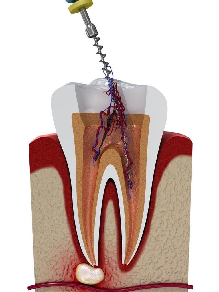Лечение пульпита