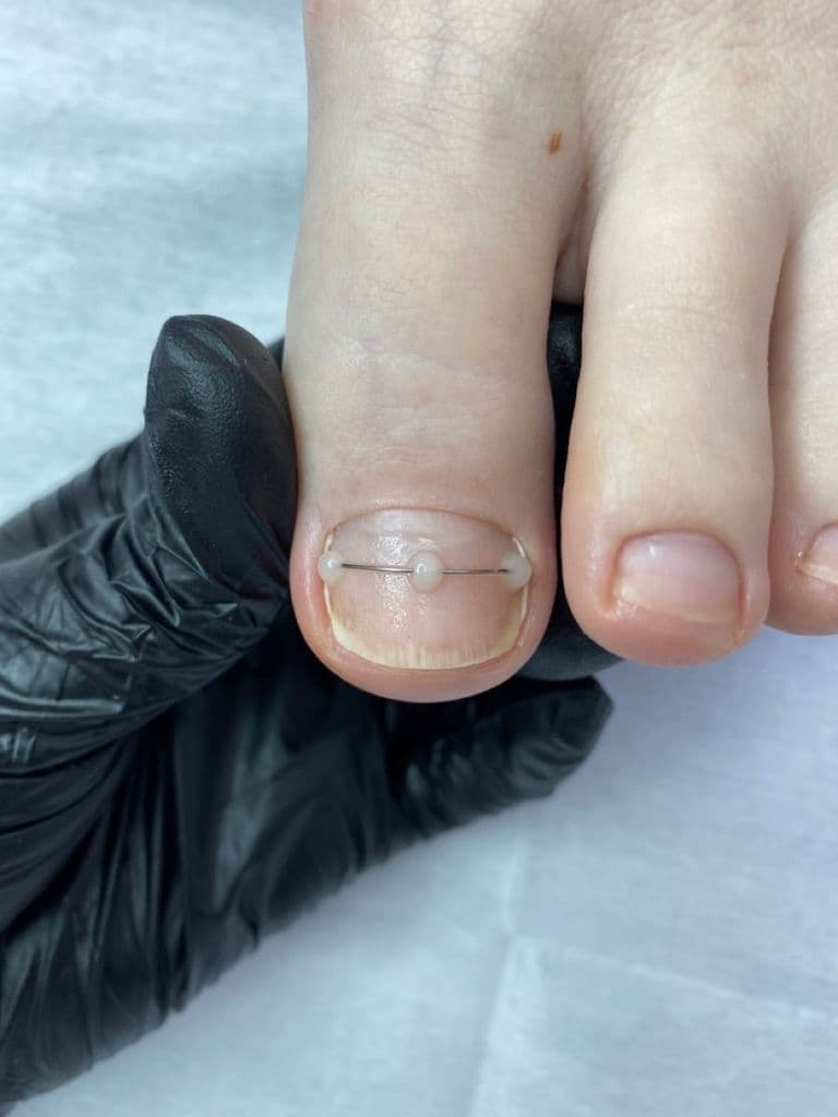 Коррекция вросшего ногтя + установка титановой нити