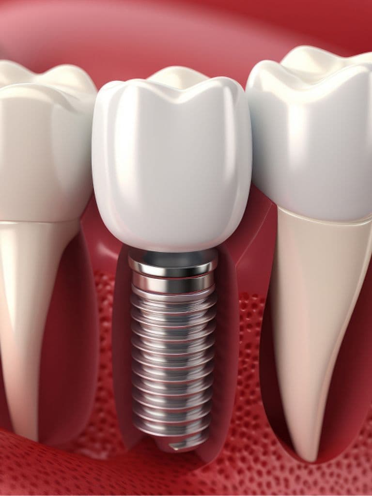 Имплантация под ключ с диоксид циркониевой коронкой