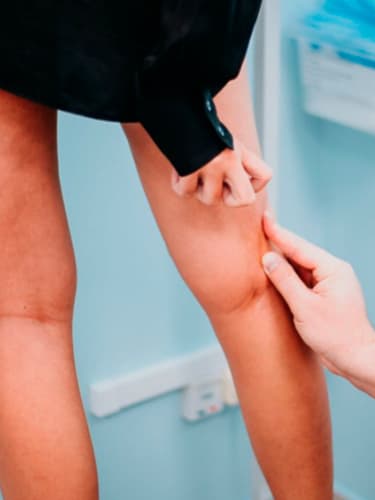 Удаление сосудистых звездочек на ногах (склеротерапия)