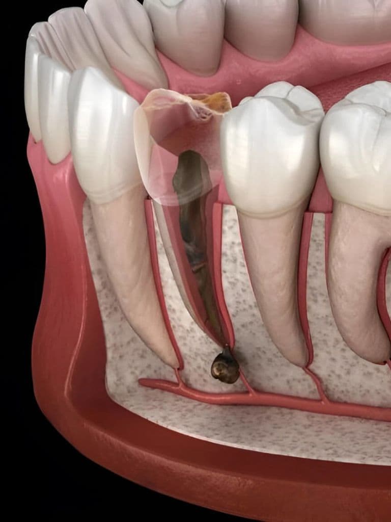 Лечение периодонтита