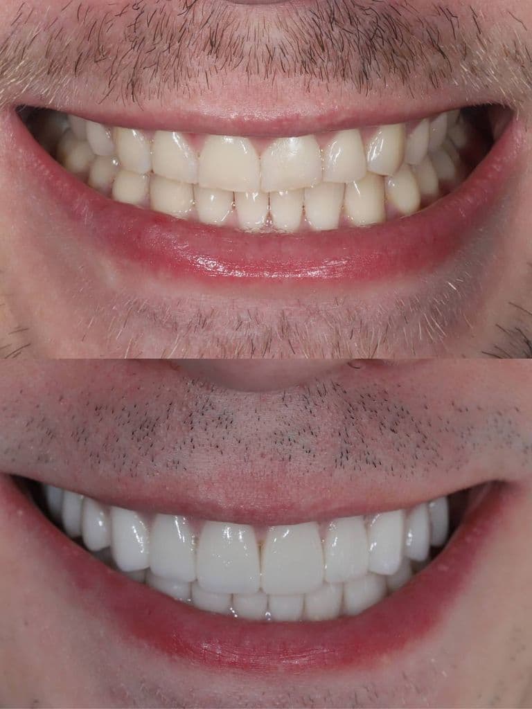 Установка керамической коронки E-max Noritake (Япония)