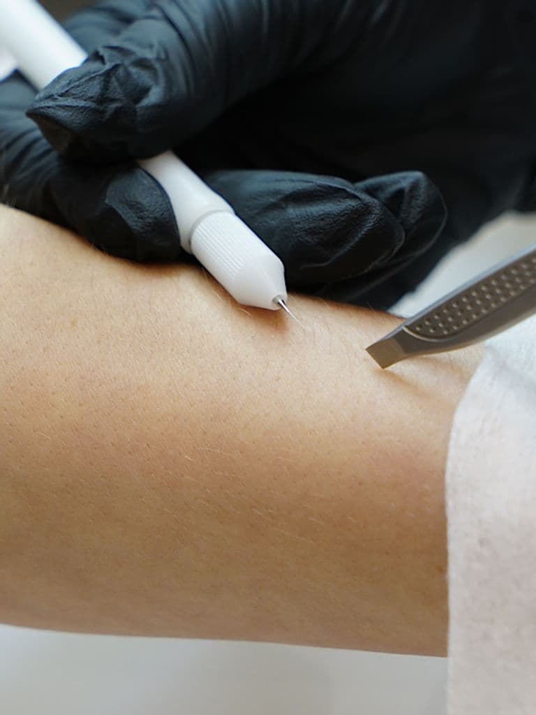 Электроэпиляция зоны на выбор