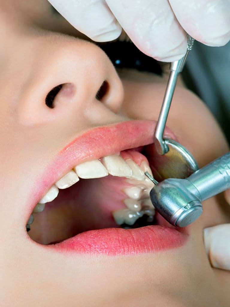 Лечение кариеса