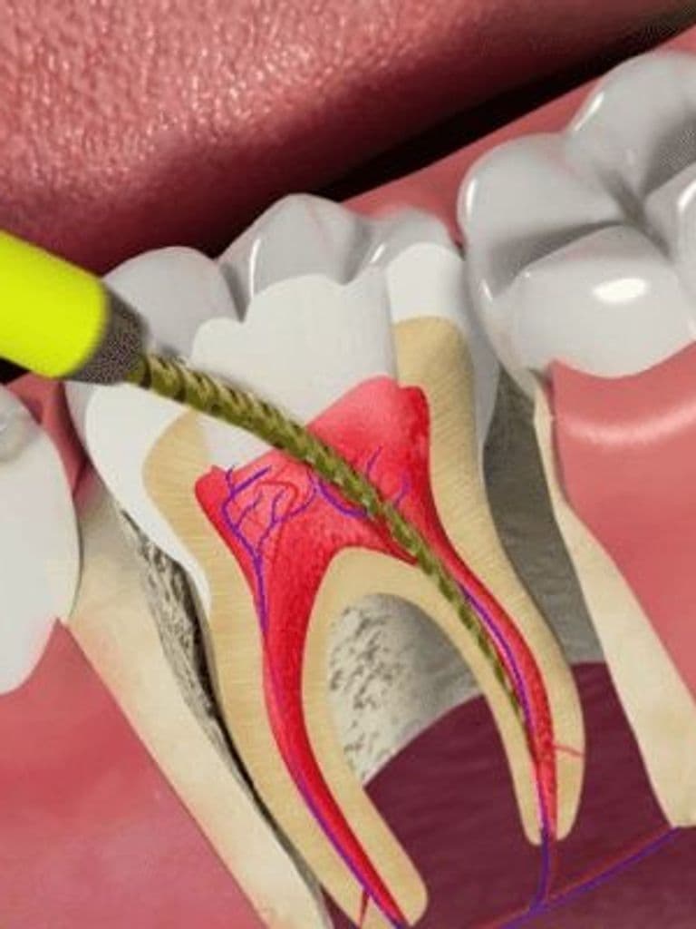 Лечение пульпита