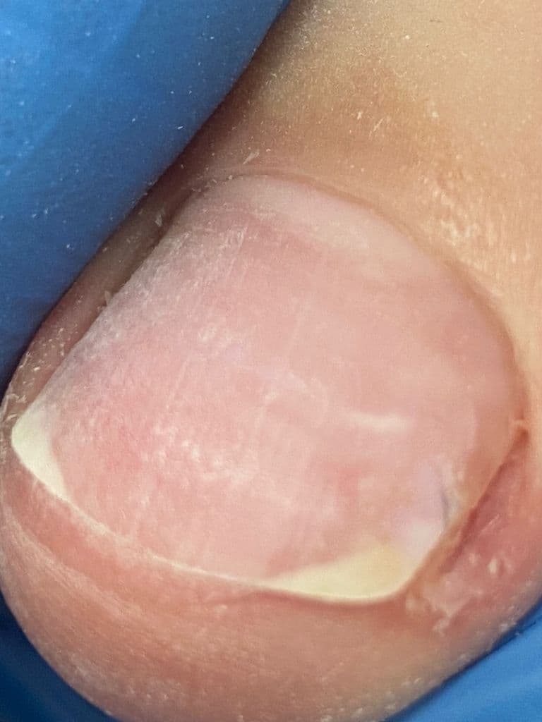 Коррекция вросшего ногтя + установка тампонады