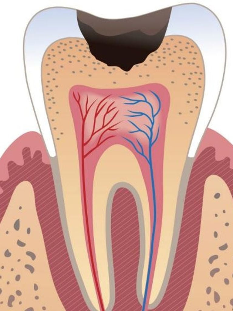 Лечение кариеса