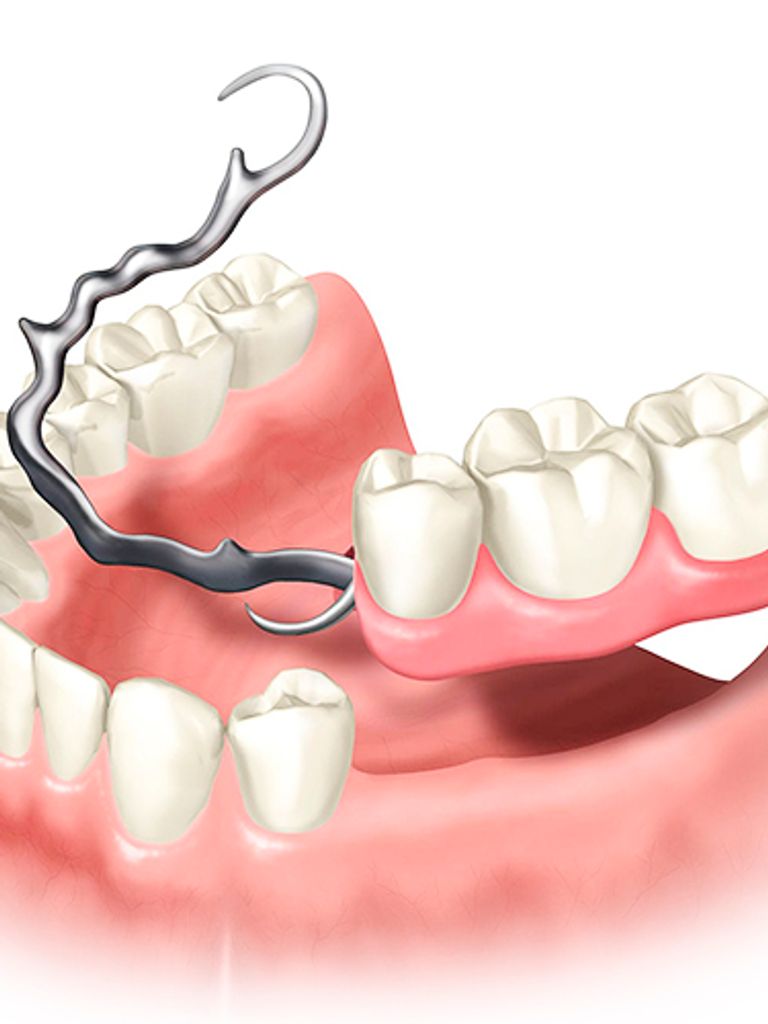 Частичный съемный протез