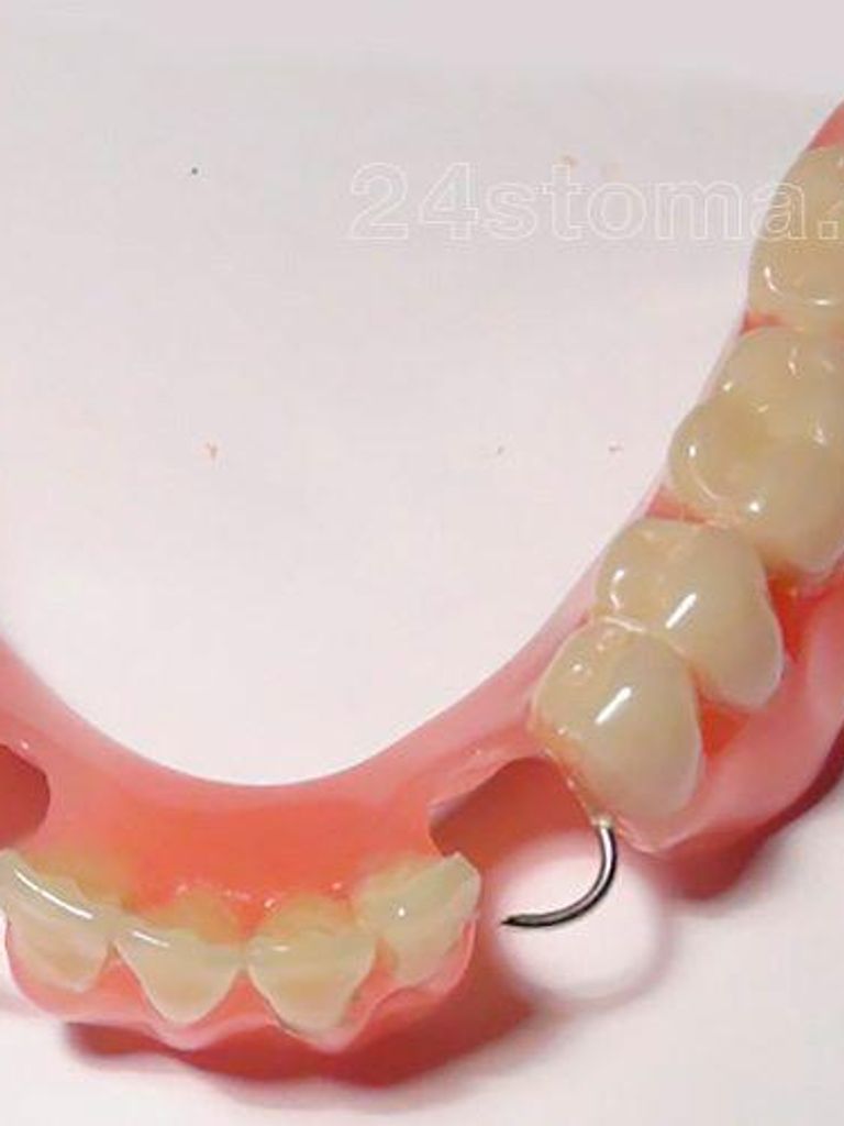 Частичносъемный протез