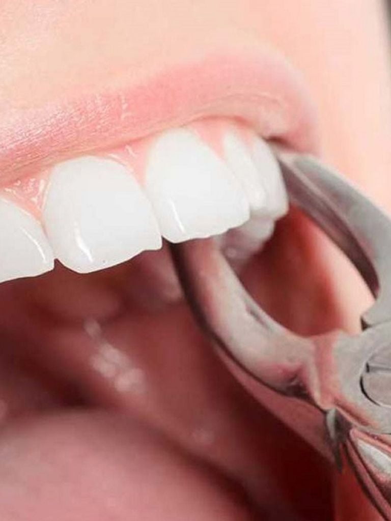 Удаление зуба