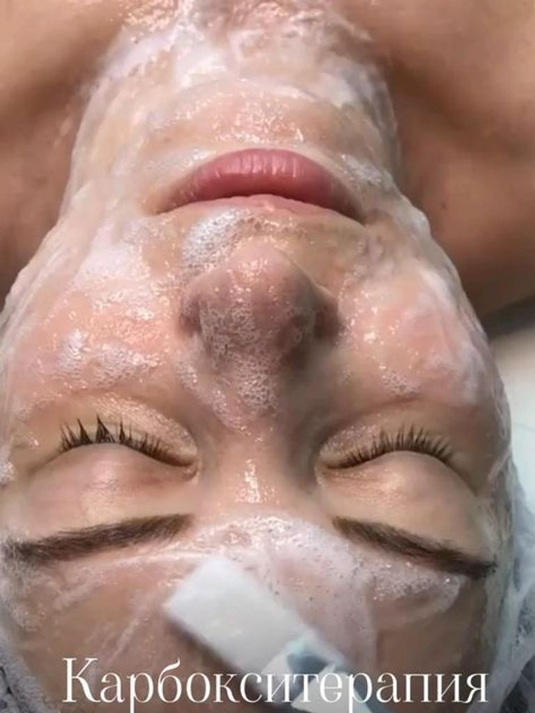 Карбокситерапия лица (неинвазивная)
