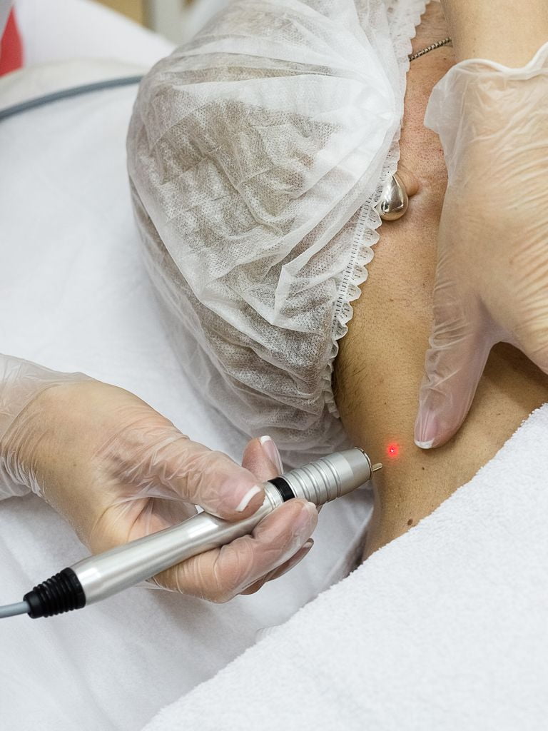 Лазерное удаление новообразований