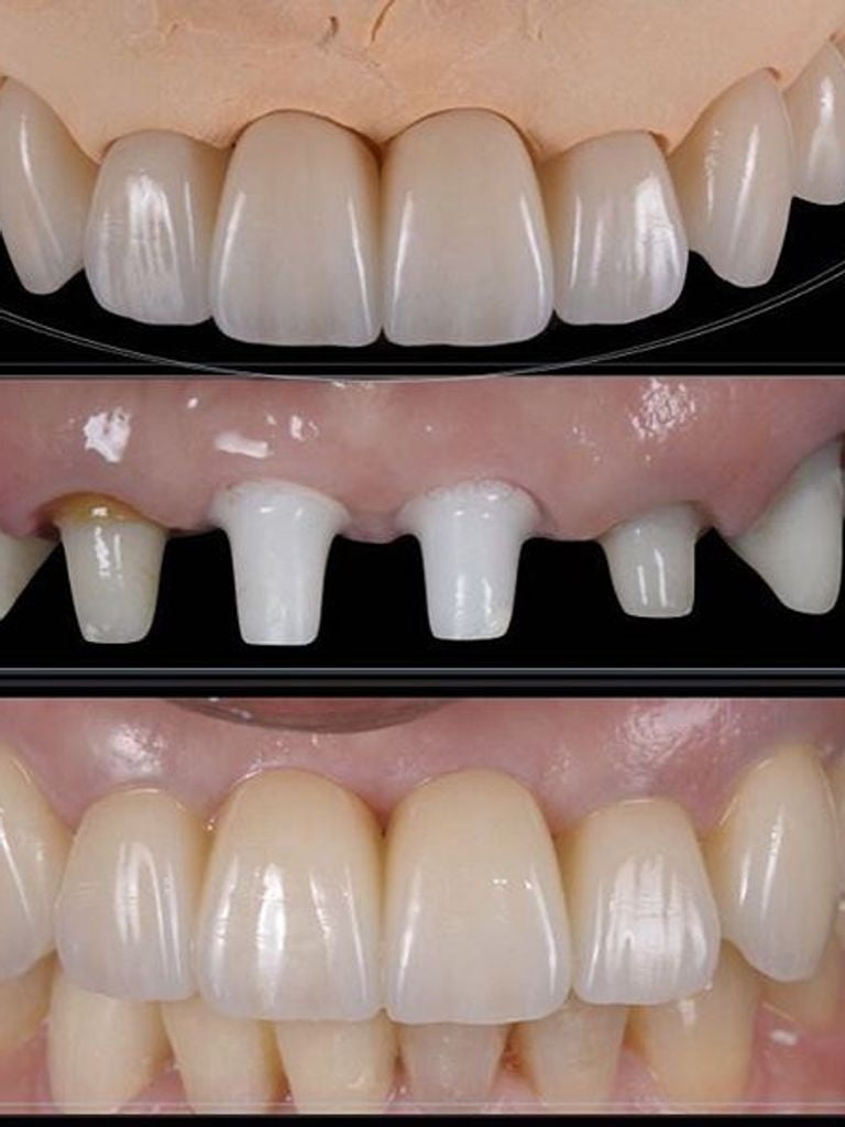 Установка коронки на зуб