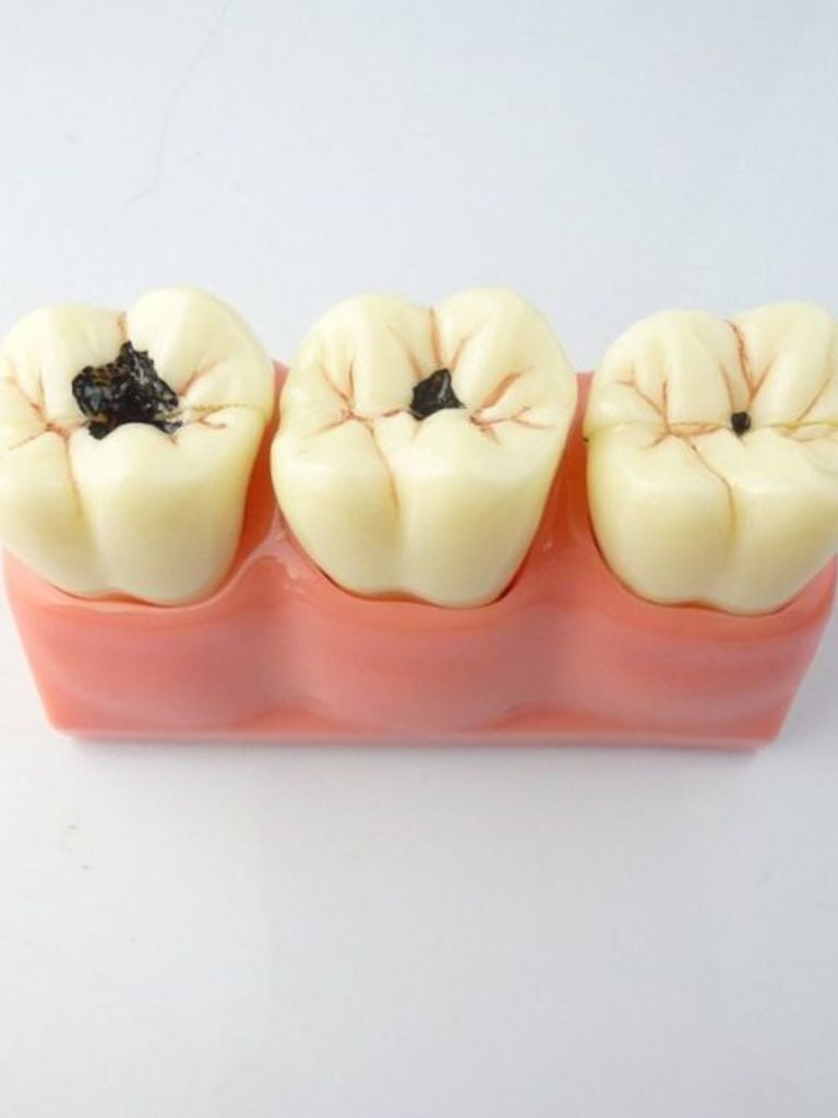 Лечение кариеса