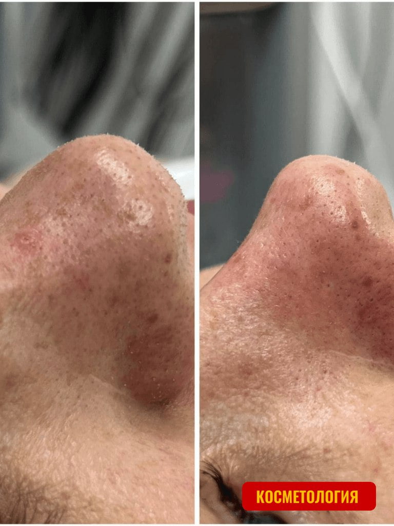 УЗ-чистка лица, 60 мин.