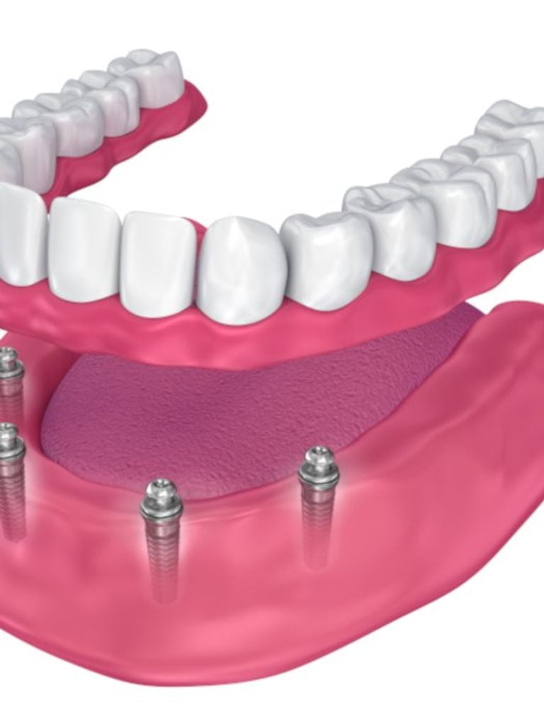 Протезирование на имплантах коронкой