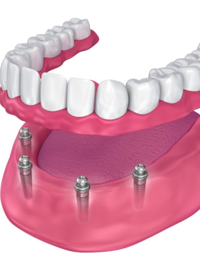 Протезирование на имплантах металлокерамической коронкой