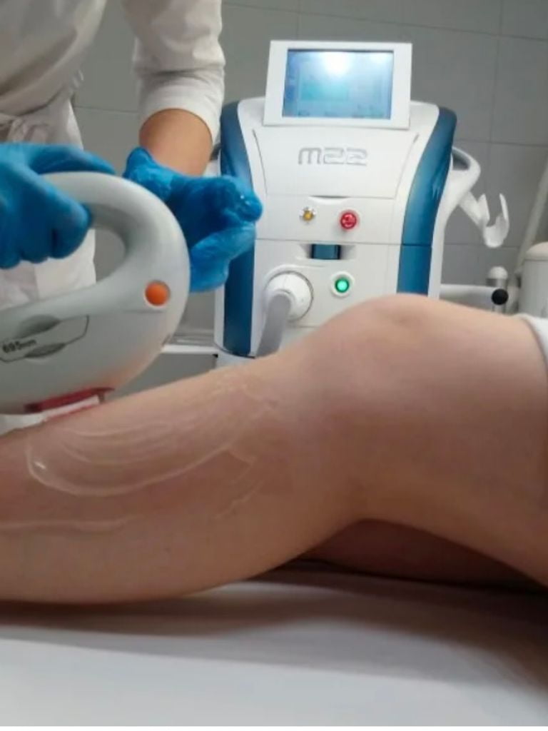 Лазерная эпиляция (аппарат М22)