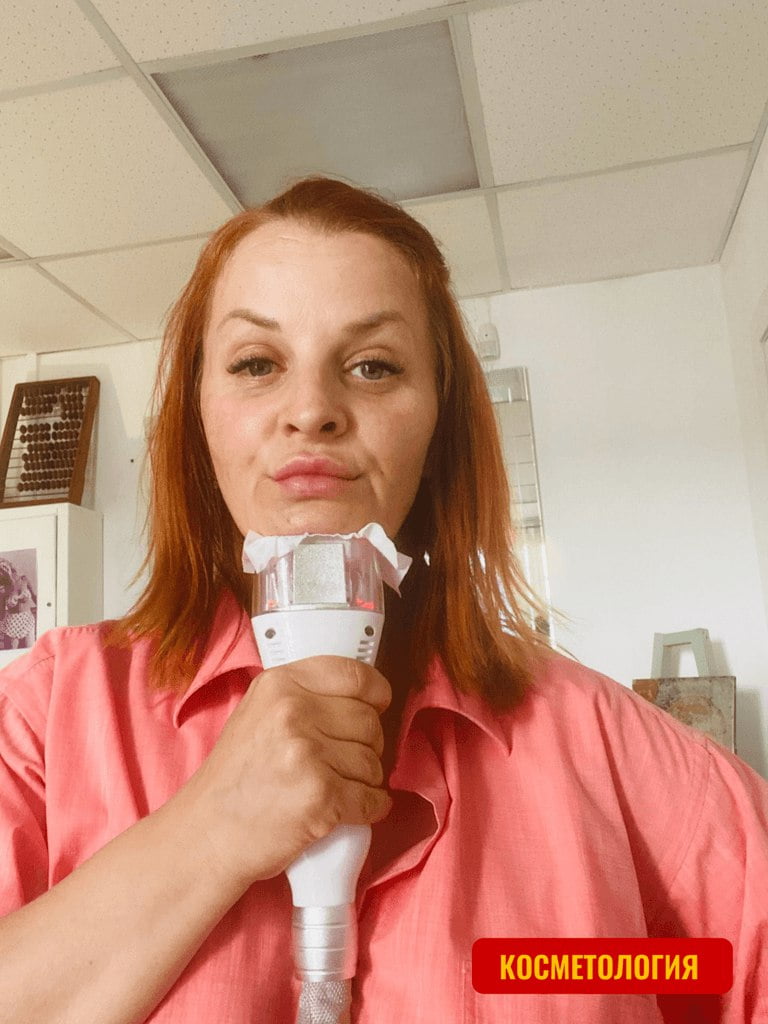 Криолиполиз зоны второго подбородка, 35 мин.