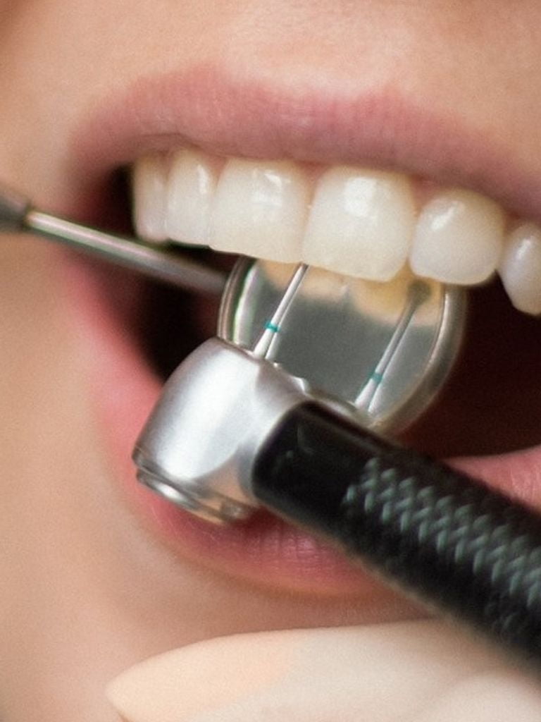 Лечение кариеса любой сложности до 14:00