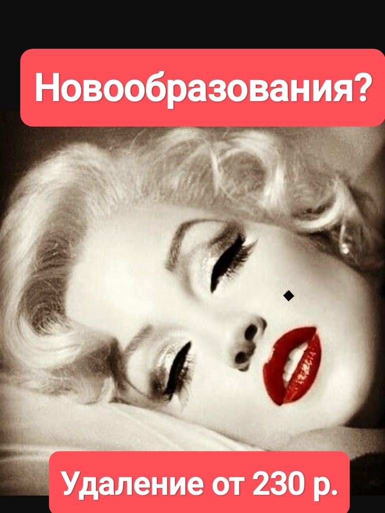 Удаление новообразований до 3 мм (метод коагуляции)