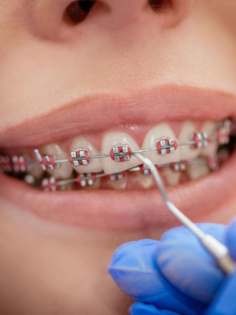 Брекет-система