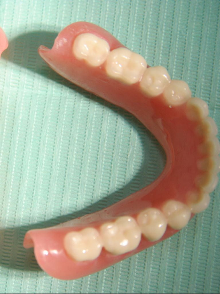 Изготовление полного съемного протеза Villacryl на 1 челюсть