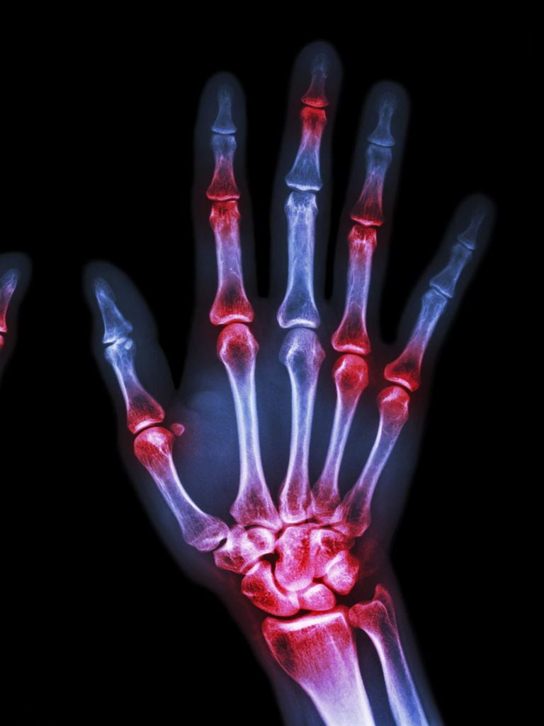 Лабораторное обследование при ревматоидном артрите