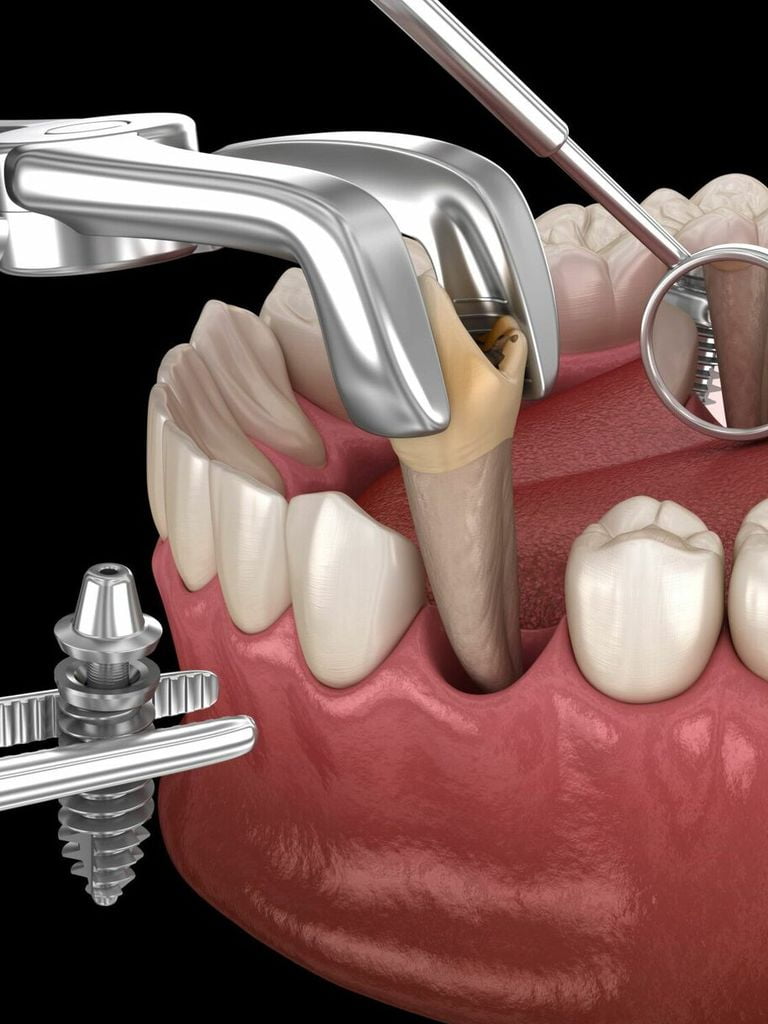 Имплантация 1 зуба Implantium (Корея) (имплант + коронка)