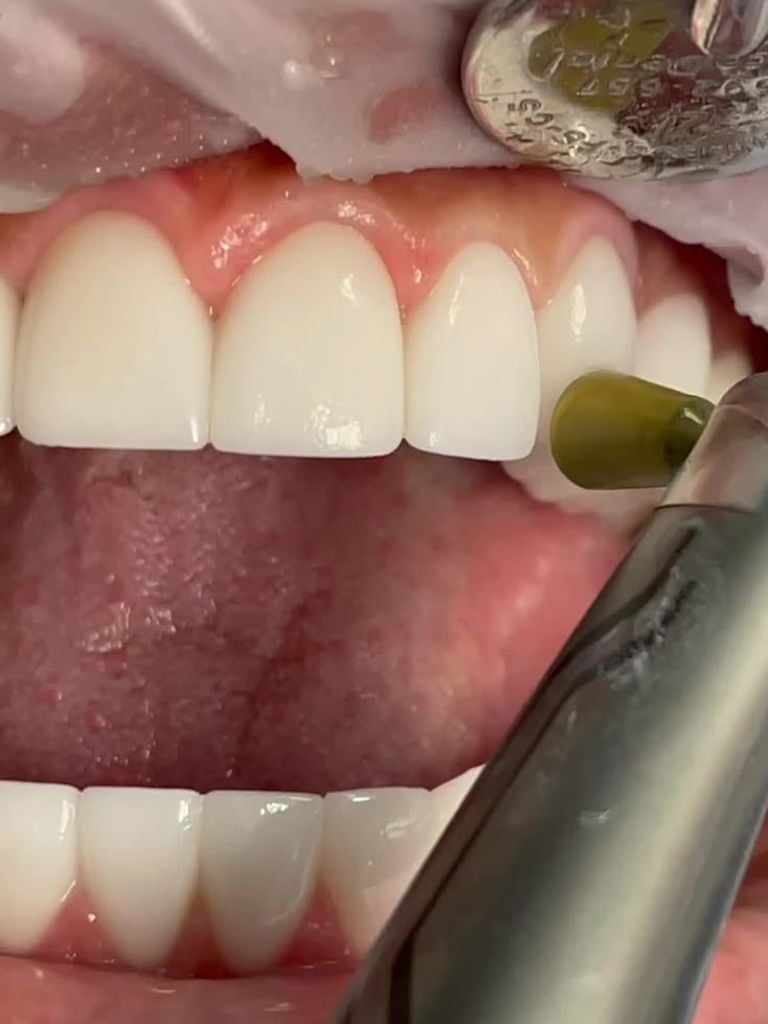 Ультразвуковая чистка зубов