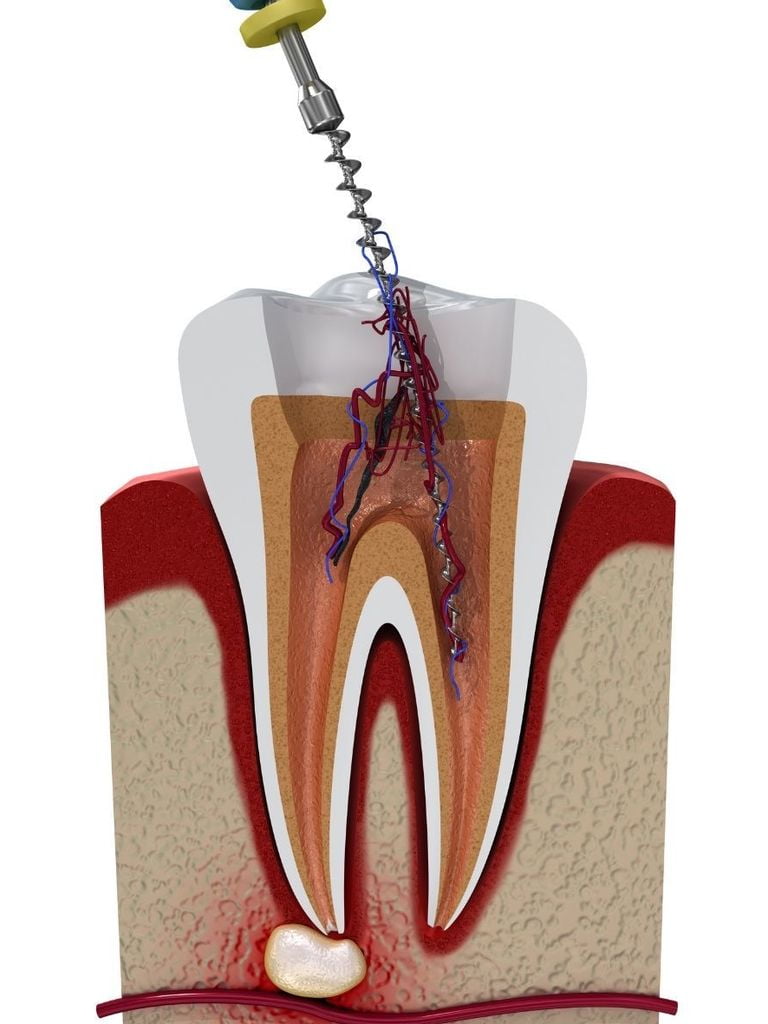 Лечение пульпита