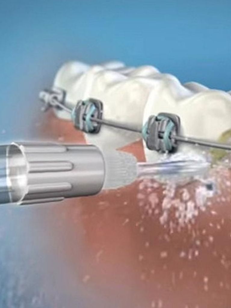 Гигиена полости рта с Air Flow для пациентов с брекетами